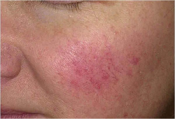 Rosacea Causes And Ways To Manage Symptoms