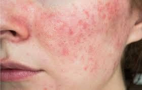 More recently, I have been seeing lots of clients with compromised skin - Acne, dryness, sensitivity and premature ageing.  If you are currently suffering from one or more of these skin concerns, it may well be that your skin's pH balance is out of kilter.