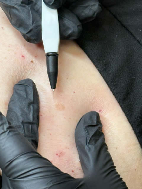 Advanced Electrolysis