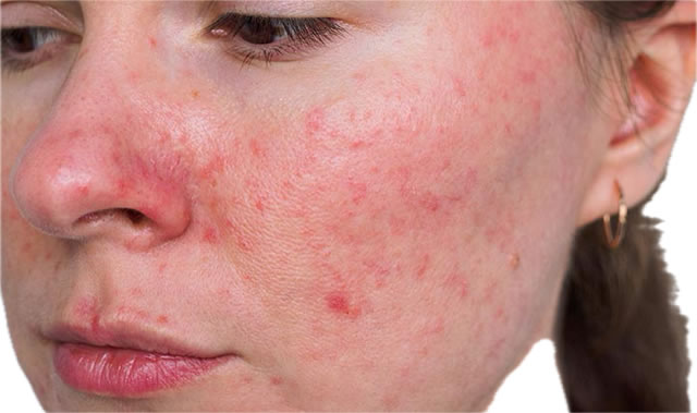 Rosacea