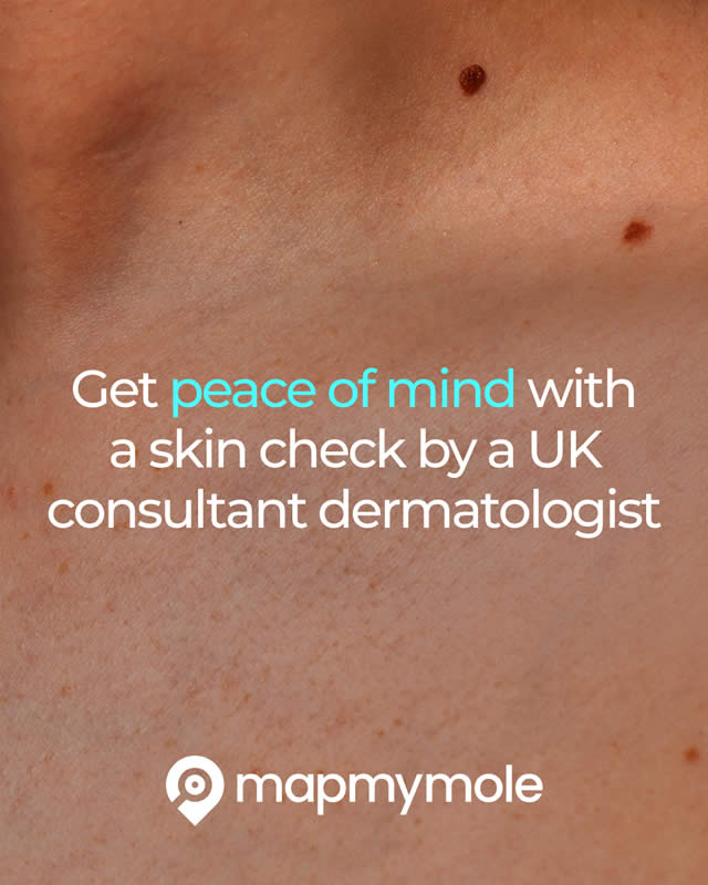 Map my mole