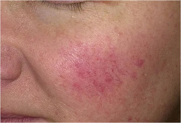 rosacea